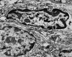 F,41y. | synovial metaplasia - capsule of implantate